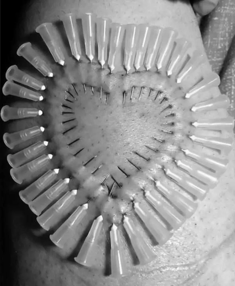 OPREZ, NIJE ZA OSJETLJIVE! Od ovog modnog trenda imat ćete noćne more - oni koriste medicinske igle kao nakit!