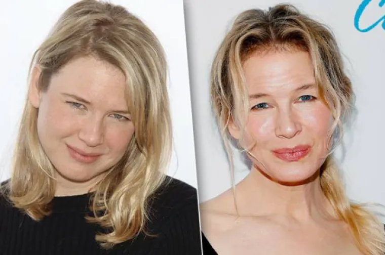 JE LI IM TO STVARNO TREBALO? Zvijezde povećale usne, pogledajte kako su izgledale prije, a kako nakon operacije