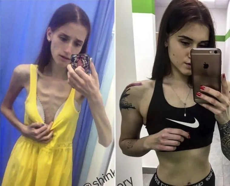 Vera Shulz je djevojka iz Rusije koja se borila s teškim poremećajem prehrane, no tri godine nakon što je dotakla dno s 30 kilograma, postala je pravi fitnes model. Njezinu borbu s anoreksijom i rezultate nakon oporavka možete pogledati u nastavku.