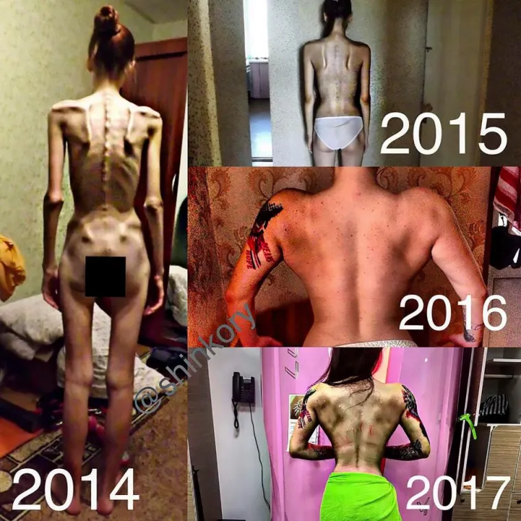 ČUDESNO SE OPORAVILA OD ANOREKSIJE: Imala je 30 kilograma, a danas se hvali oblinama i fotkama iz teretane