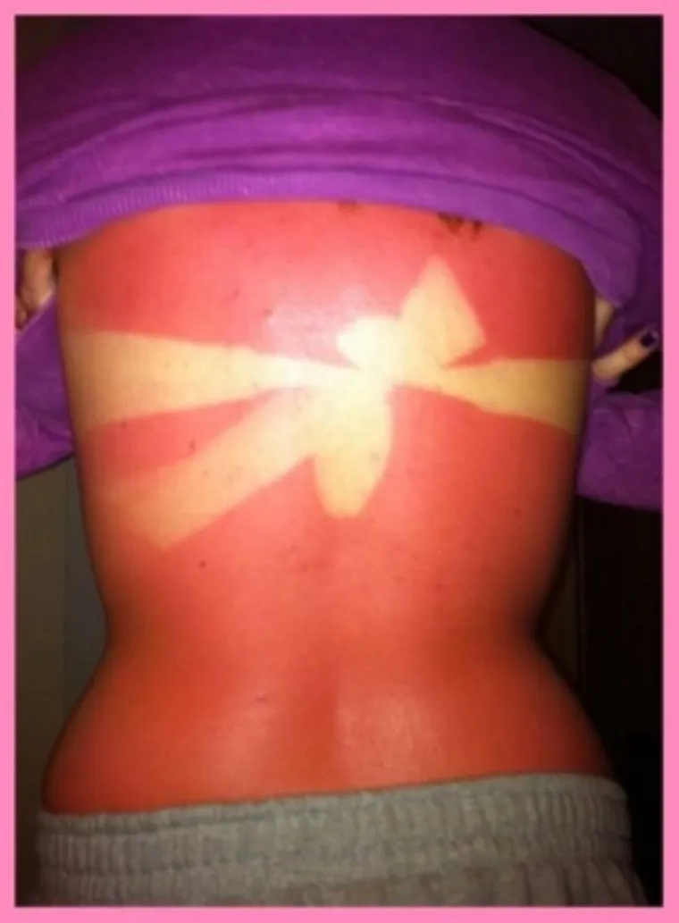 LJETO JE GOTOVO, ALI OPEKLINE OSTAJU: Previ&scaron;e se sunčali pa su im ostale ljetne uspomene koje nikako nisu željeli