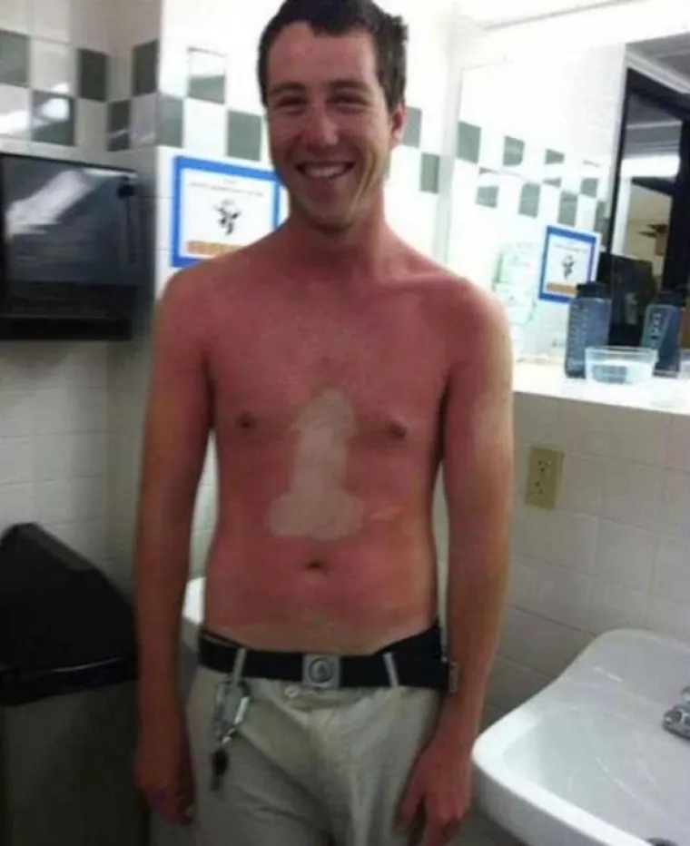 LJETO JE GOTOVO, ALI OPEKLINE OSTAJU: Previ&scaron;e se sunčali pa su im ostale ljetne uspomene koje nikako nisu željeli