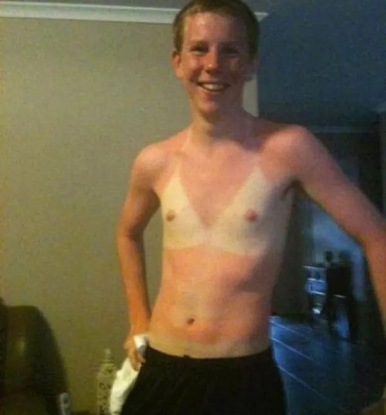 LJETO JE GOTOVO, ALI OPEKLINE OSTAJU: Previ&scaron;e se sunčali pa su im ostale ljetne uspomene koje nikako nisu željeli