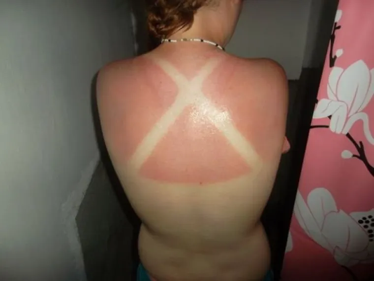 LJETO JE GOTOVO, ALI OPEKLINE OSTAJU: Previ&scaron;e se sunčali pa su im ostale ljetne uspomene koje nikako nisu željeli