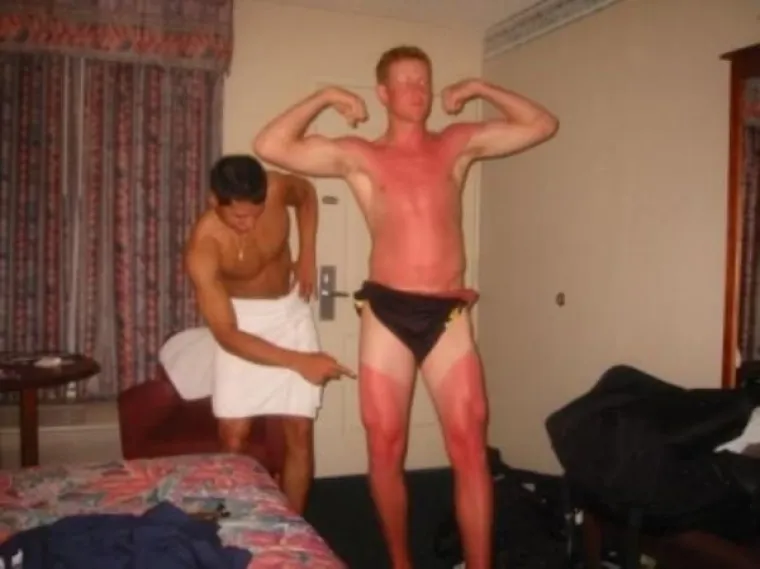 LJETO JE GOTOVO, ALI OPEKLINE OSTAJU: Previ&scaron;e se sunčali pa su im ostale ljetne uspomene koje nikako nisu željeli