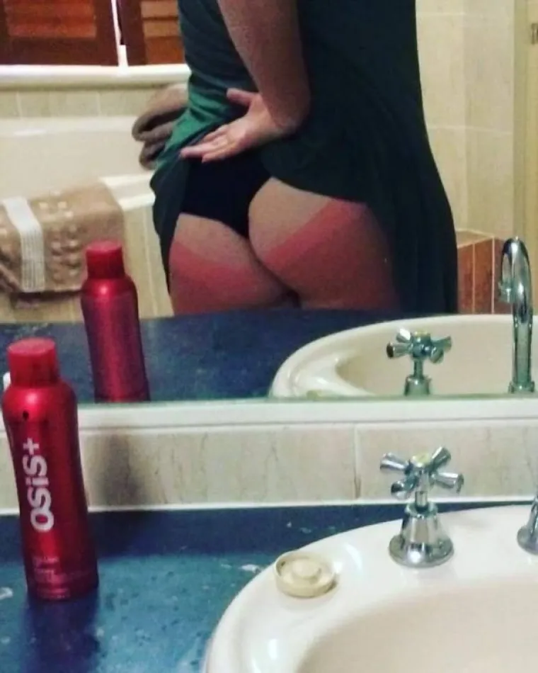 LJETO JE GOTOVO, ALI OPEKLINE OSTAJU: Previ&scaron;e se sunčali pa su im ostale ljetne uspomene koje nikako nisu željeli