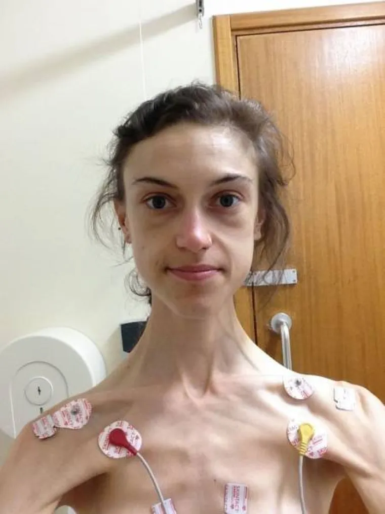 BILA JE NA RUBU SMRTI S 32 KILOGRAMA: Anoreksična djevojka objavila šokantne snimke svojeg oporavka