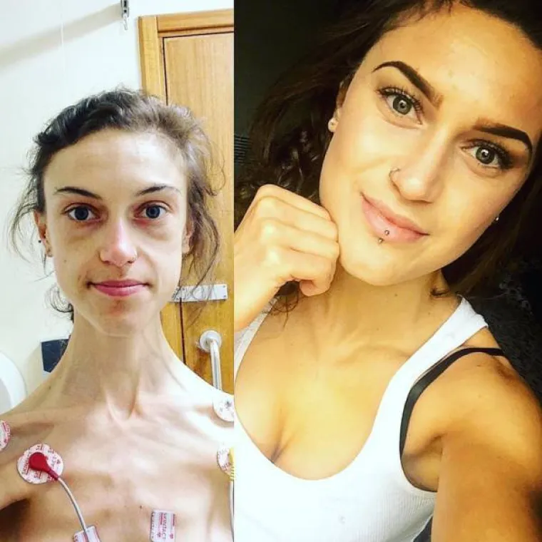 BILA JE NA RUBU SMRTI S 32 KILOGRAMA: Anoreksična djevojka objavila šokantne snimke svojeg oporavka
