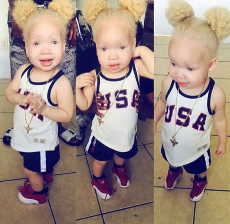 LJUDI SVIH RASA MOGU IMATI ALBINIZAM: Na&scaron;a vrsta je stvarno raznolika, a ljepota dolazi u mnogo oblika