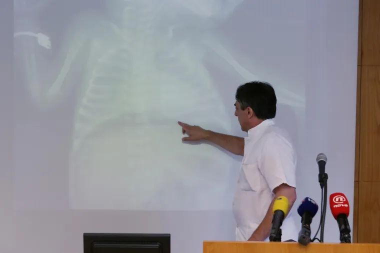 MALA MA&Scaron;A POSTALA NAJMANJA BEBA KOJA JE PREŽIVJELA TE&Scaron;KU OPERACIJU: Liječnici proslavili veliki uspjeh hrvatske medicine