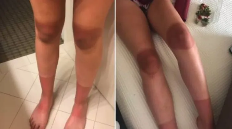 TRAPERICE S RUPAMA GORE SU NEGO ŠTO SMO MISLILI: Djevojke na vlastitoj koži otkrile bolnu istinu