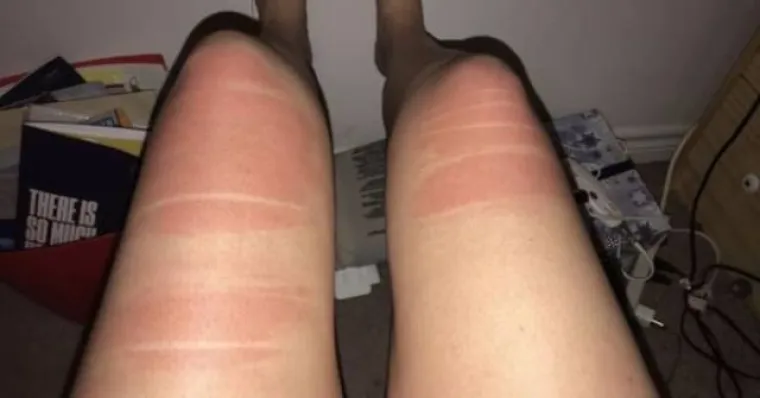 TRAPERICE S RUPAMA GORE SU NEGO ŠTO SMO MISLILI: Djevojke na vlastitoj koži otkrile bolnu istinu