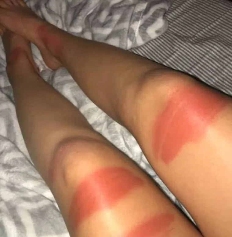 TRAPERICE S RUPAMA GORE SU NEGO ŠTO SMO MISLILI: Djevojke na vlastitoj koži otkrile bolnu istinu