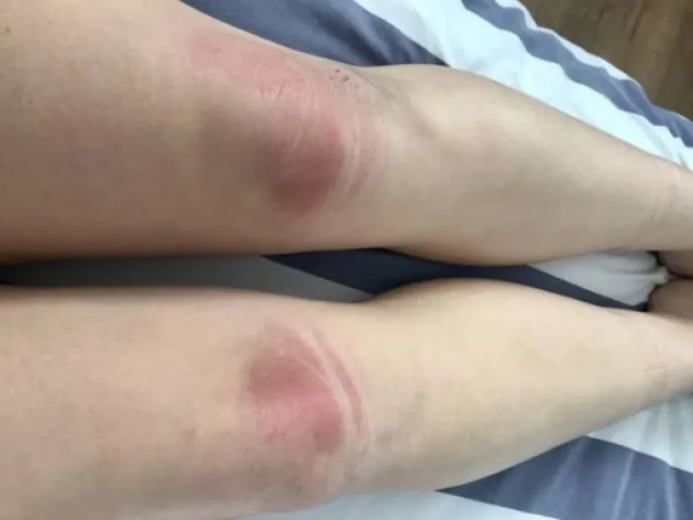 TRAPERICE S RUPAMA GORE SU NEGO ŠTO SMO MISLILI: Djevojke na vlastitoj koži otkrile bolnu istinu