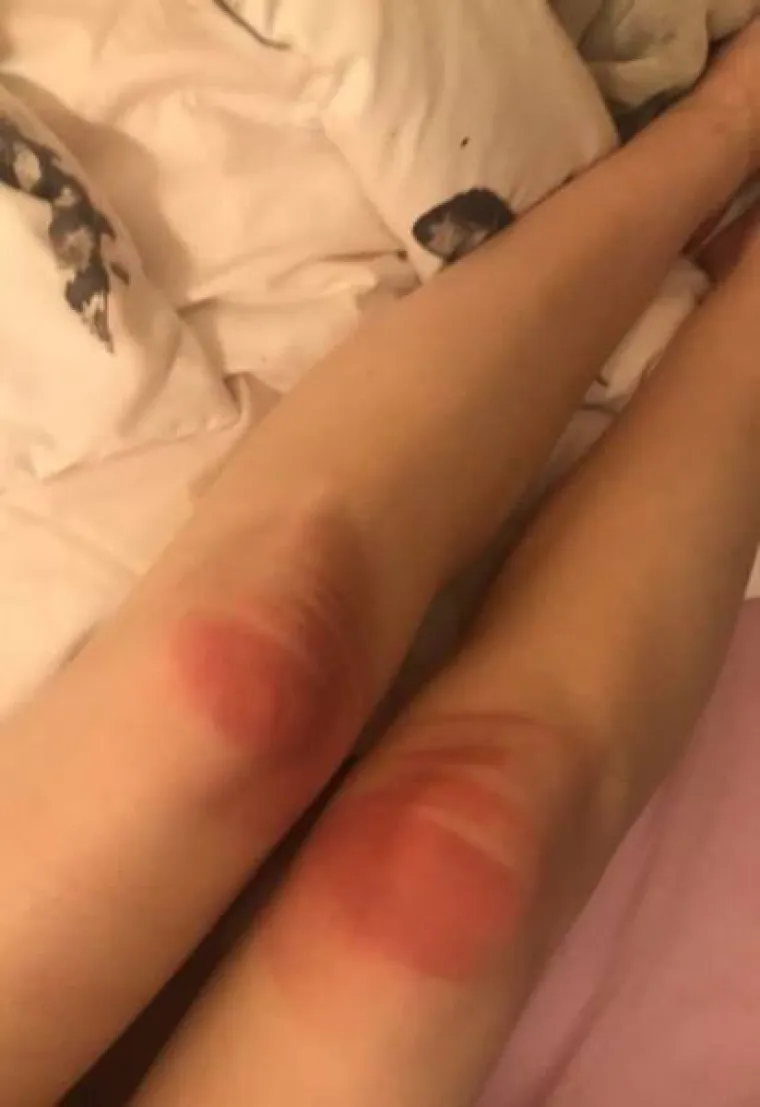 TRAPERICE S RUPAMA GORE SU NEGO ŠTO SMO MISLILI: Djevojke na vlastitoj koži otkrile bolnu istinu
