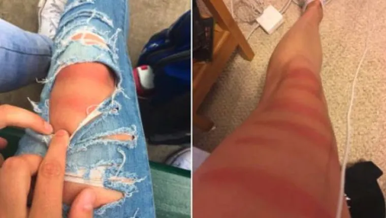 TRAPERICE S RUPAMA GORE SU NEGO ŠTO SMO MISLILI: Djevojke na vlastitoj koži otkrile bolnu istinu