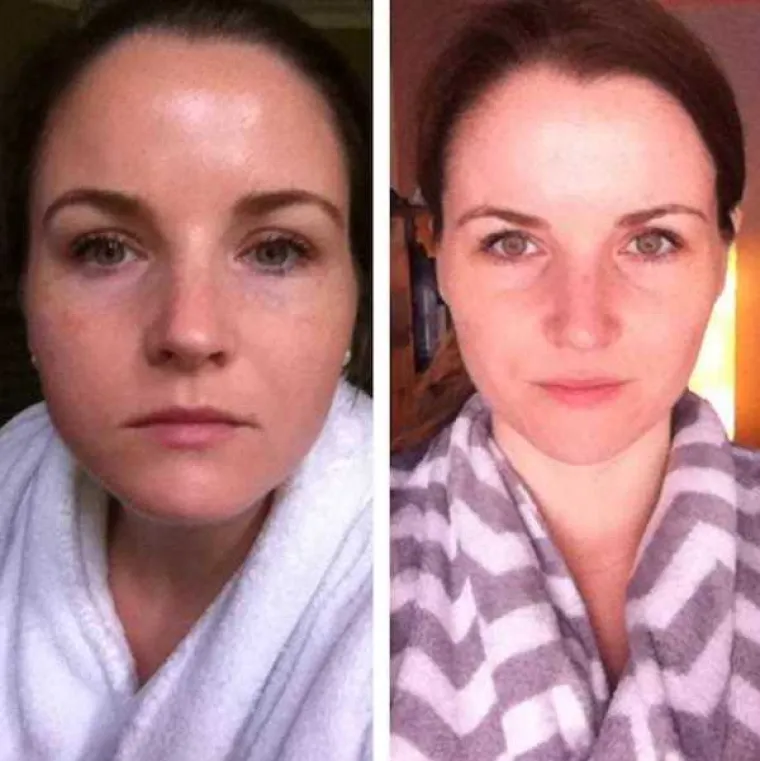 NEVJEROJATNO &Scaron;TO SE TIJELU DOGODI KADA PRESTANETE PITI ALKOHOL: Podijelili svoje preobrazbe na dru&scaron;tvenim mrežama