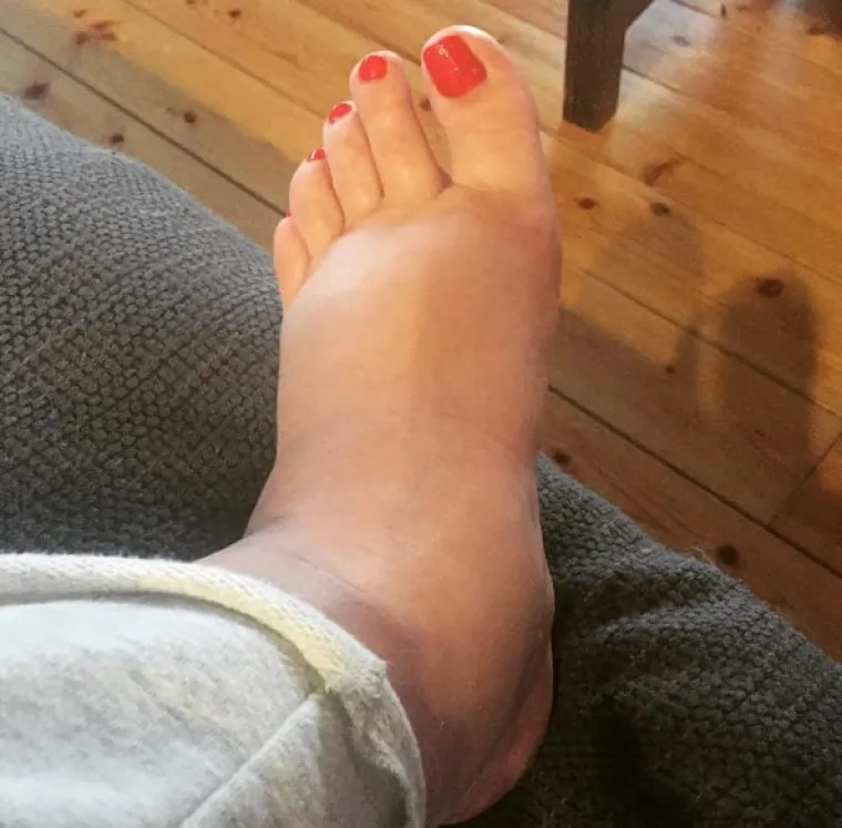 Nije nosila određene cipele jer su joj noge kao buhtle.