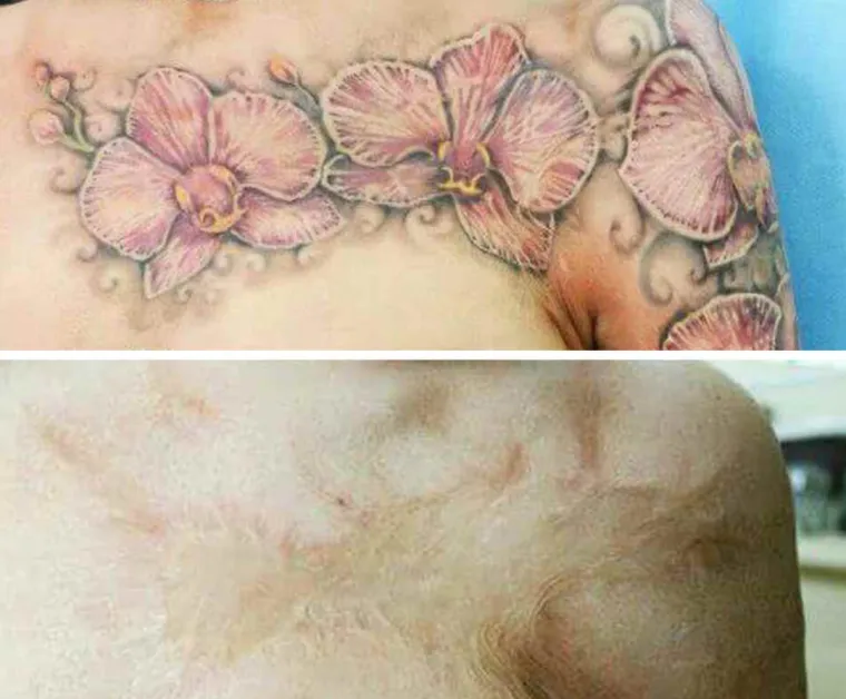 Njihovi ožiljci postali su umjetnost: pogledajte kako fascinantne tetovaže daju novo ruho ožiljcima