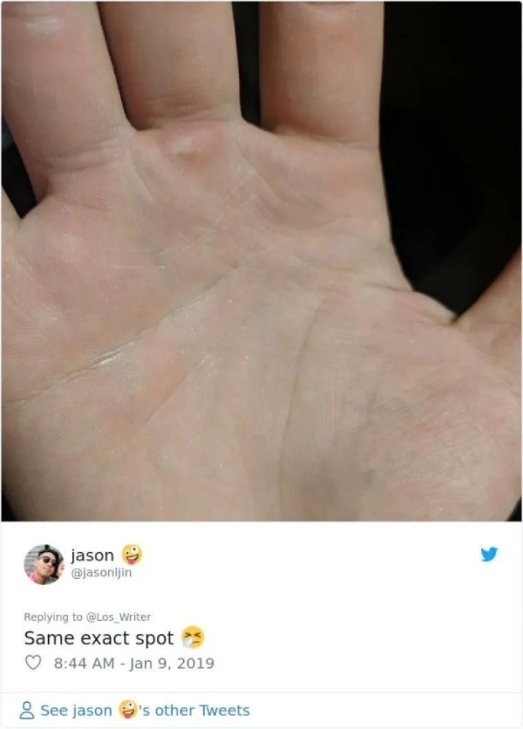 MISLIO DA JE JEDINI I POKRENUO LAVINU NA TWITTERU: Imate li i vi ovakav ožiljak iz osnovnjaka?