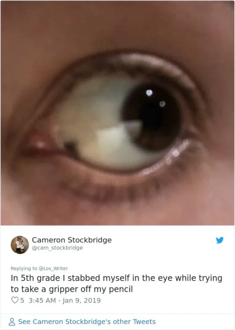 U petom razredu sam se ubola u oko kad sam poku&scaron;avala skinuti držač s olovke