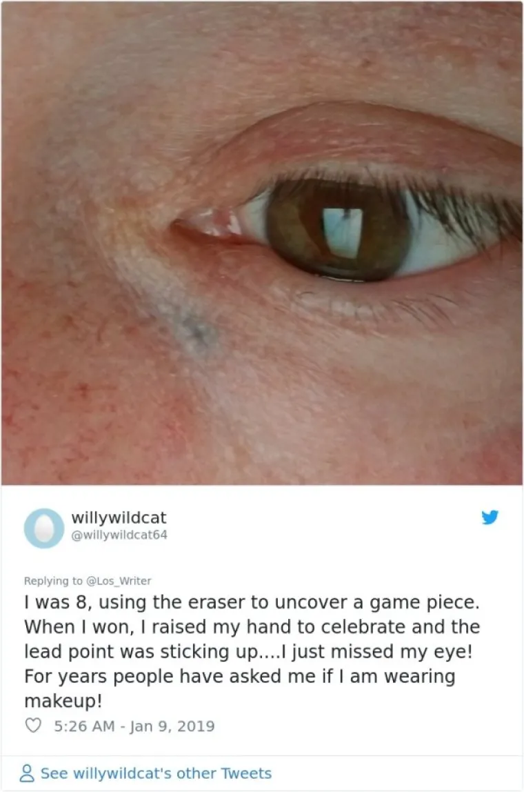 Iamo sam 8 godina, koristio sam u gumicu u igri i kad sam pobijedio digao ruke da proslavim... zamalo sam proma&scaron;io oko. Godinama me ljudi pitaju koristim li &scaron;minku