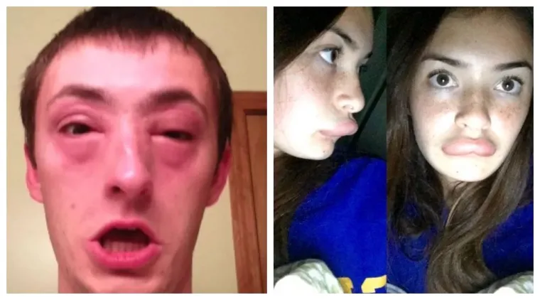 Nije za one slabijeg želudca: 20 najgorih alergijskih reakcija kojih smo vidjeli do sada