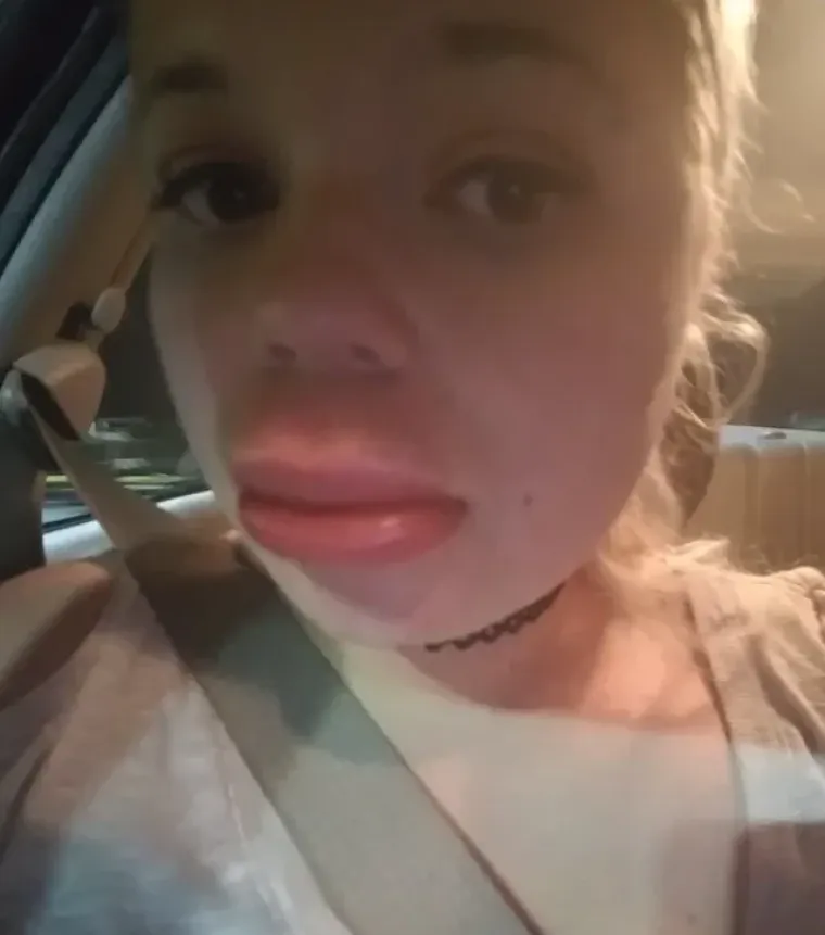 Nije za one slabijeg želudca: 20 najgorih alergijskih reakcija kojih smo vidjeli do sada