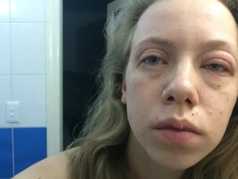 Nije za one slabijeg želudca: 20 najgorih alergijskih reakcija kojih smo vidjeli do sada