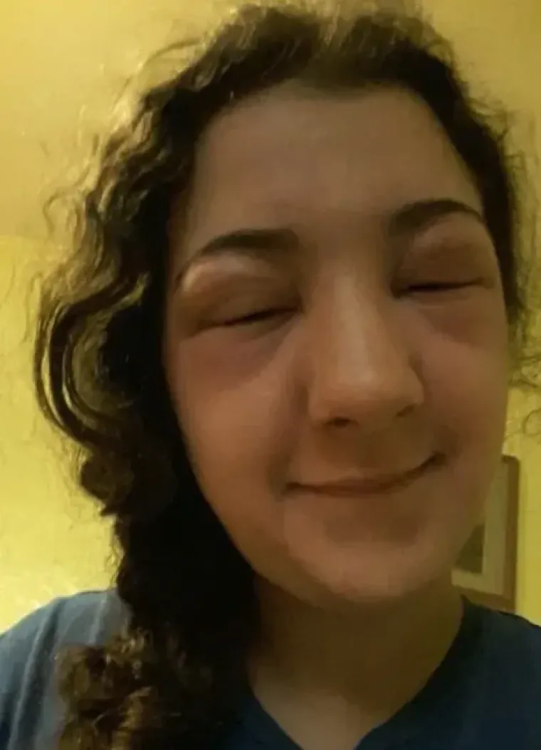 Nije za one slabijeg želudca: 20 najgorih alergijskih reakcija kojih smo vidjeli do sada