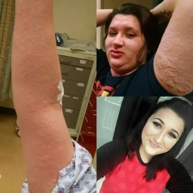 Nije za one slabijeg želudca: 20 najgorih alergijskih reakcija kojih smo vidjeli do sada