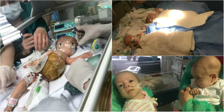 Pogledajte nove fotografije s operacije sijamskih blizanki!