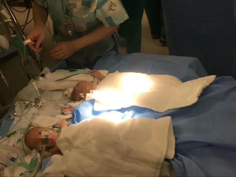 Pogledajte nove fotografije s operacije sijamskih blizanki!