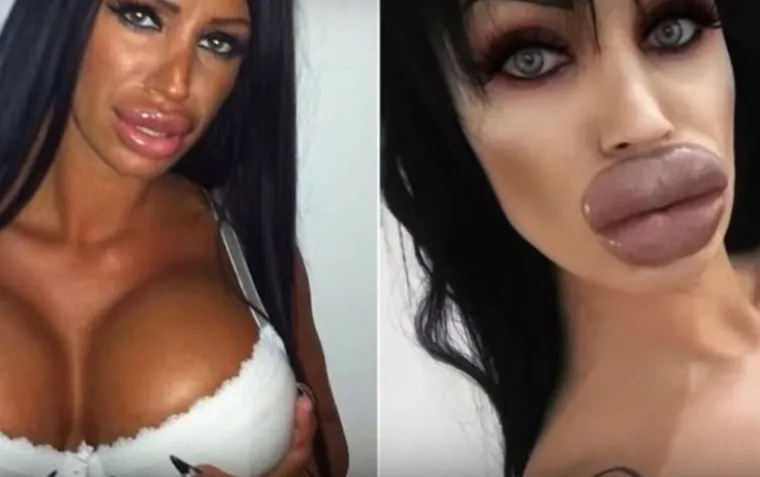 20 osoba koje su 'malo' pretjerale s plastičnim operacijama, njihove slike postale su viralne