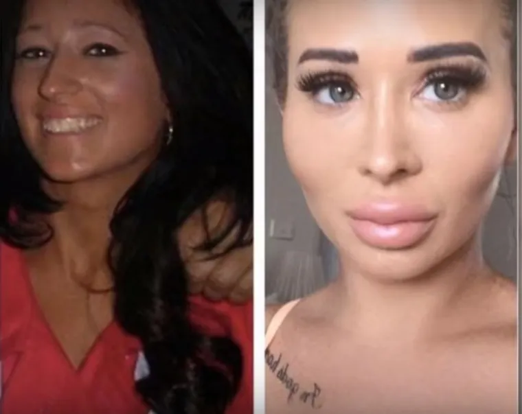 20 osoba koje su 'malo' pretjerale s plastičnim operacijama, njihove slike postale su viralne