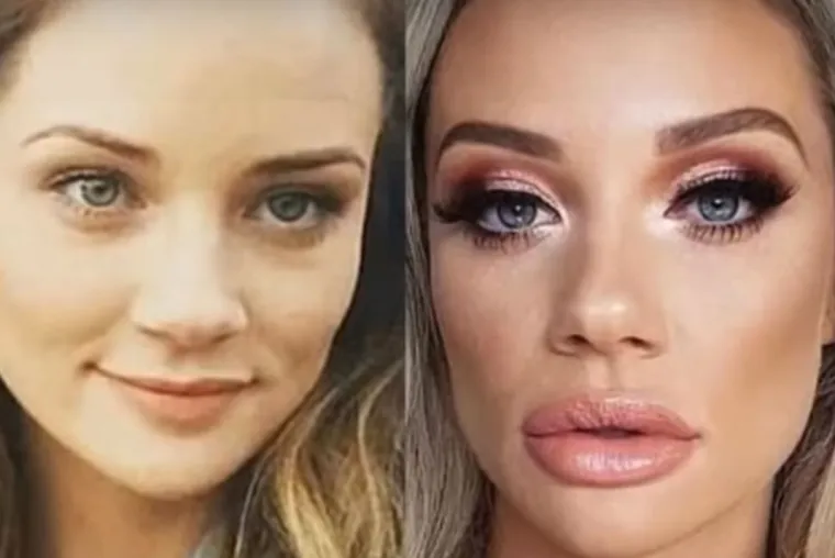 20 osoba koje su 'malo' pretjerale s plastičnim operacijama, njihove slike postale su viralne