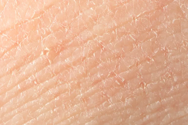 Usporeni metabolizam uzrokovan hipotireozom utječe na cirkulaciju i opskrbu kože hranjivim tvarima. Manje znojenja i sporija regeneracija stanica kože rezultiraju suhoćom i svrbežom. Koža postaje grublja, a može doći i do pojave pukotina.