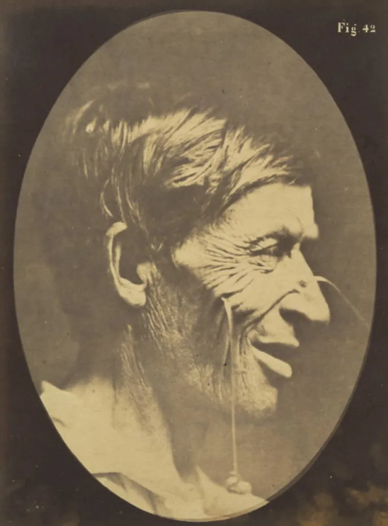 Liječnik Guillaume-Benjamin-Amand Duchenne de Boulogne  prvi je objasnio ono &scaron;to svi instinktivno prepoznajemo - razliku između lažnog osmijeha (koji koristi samo mi&scaron;iće lica) i iskrenog osmijeha ( koji steže i mi&scaron;iće oko očiju). A kako je do&scaron;ao do toga? Pa, između 1854. i 1856. elektrodama je grčio mi&scaron;iće lica i poku&scaron;avajući stvoriti karakteristične izraze lica za bijes, ljutnju...