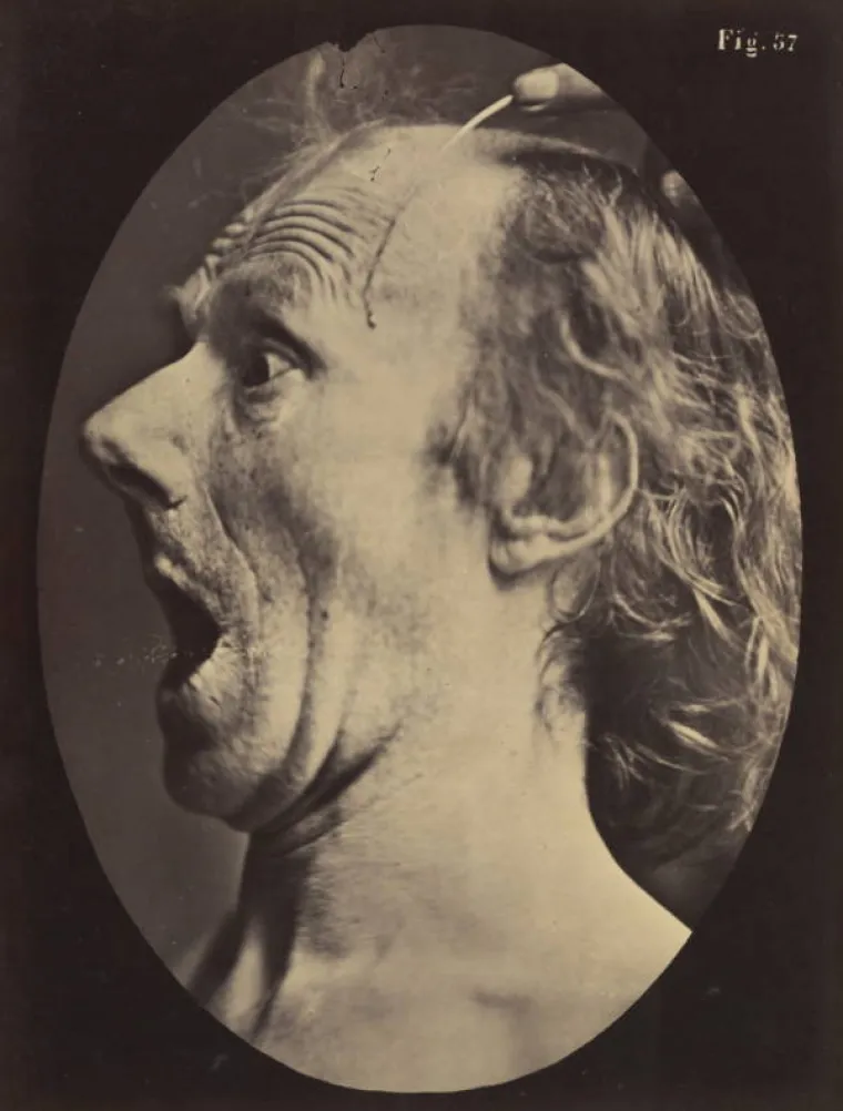 JEZIVE SLIKE LIJEČNIČKIH POKUSA IZ 19. STOLJEĆA: Ova lica će vas proganjati i dok spavate