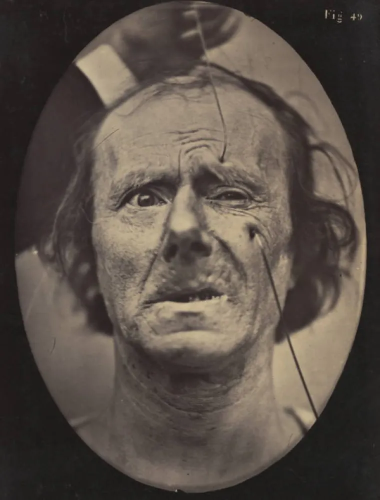 JEZIVE SLIKE LIJEČNIČKIH POKUSA IZ 19. STOLJEĆA: Ova lica će vas proganjati i dok spavate