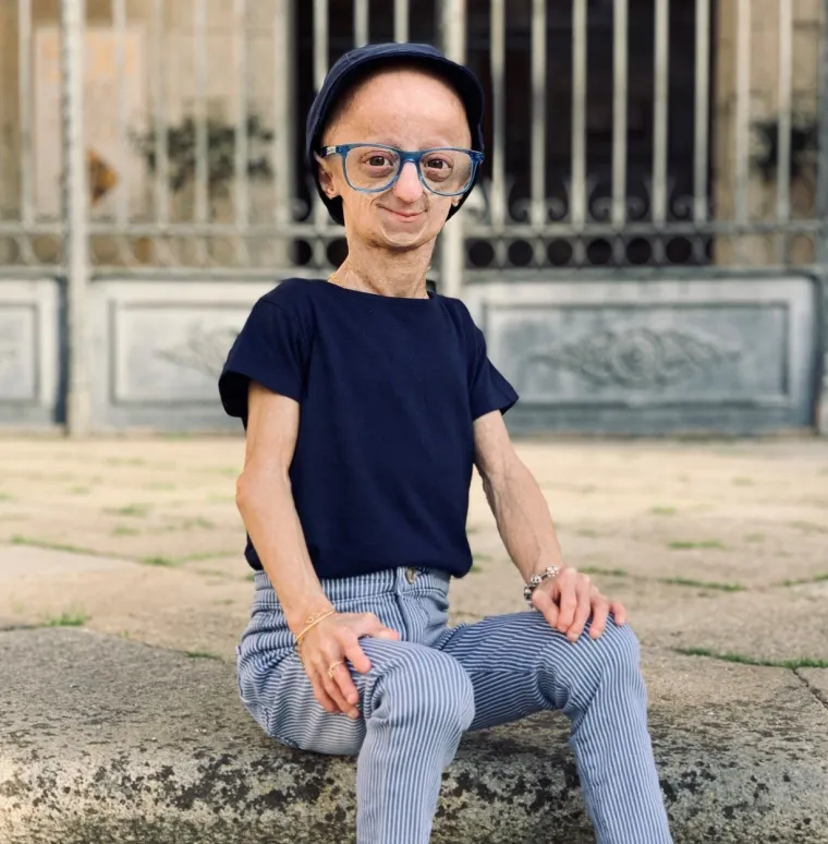 CLAUDIA STARI SEDAM PUTA BRŽE: Ima tek 20 godina, a zbog bolesti izgleda poput starice