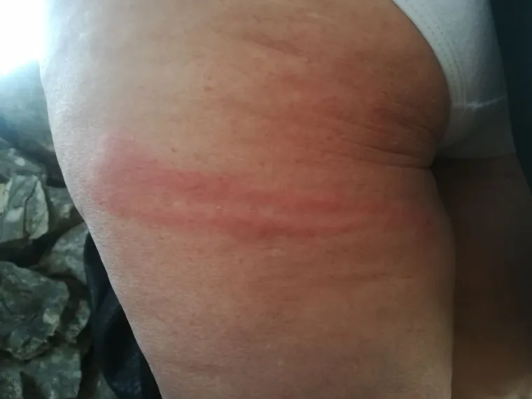 Opasni vatreni crvi potjerali kupače iz rogozničke uvale: 'Uspjela sam nekako izdržati bol'