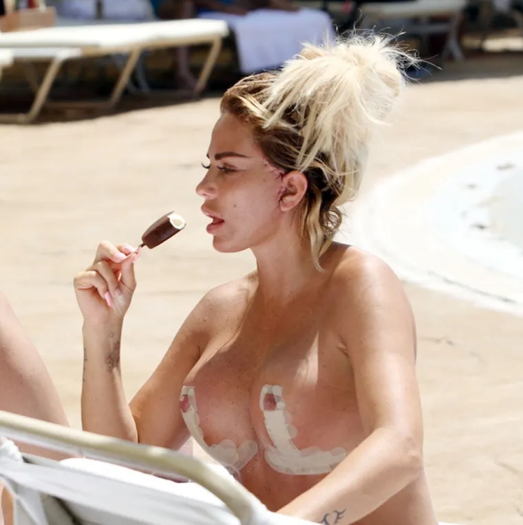 KATIE PRICE ŠOKIRALA IZGLEDOM NA BAZENU: Lice joj drže konci, a u toplesu je pokazala zavoje na grudima