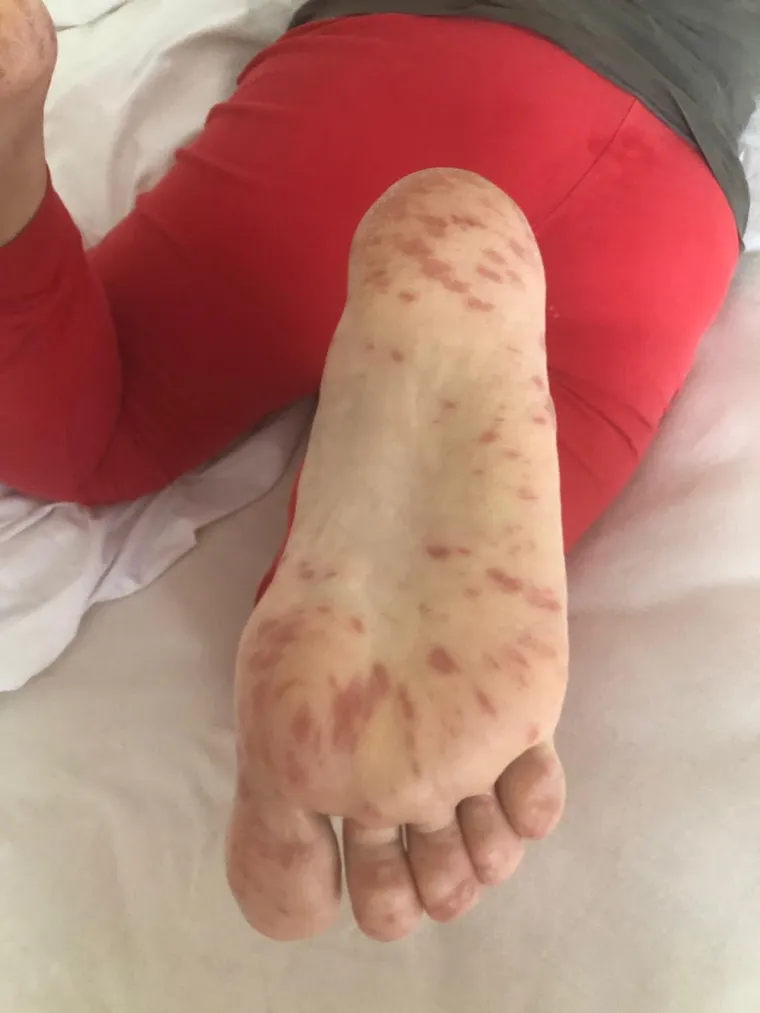 Prvo se razboljela kćerkica, a ubrzo su se temperatura i plikovi pojavili i kod roditelja