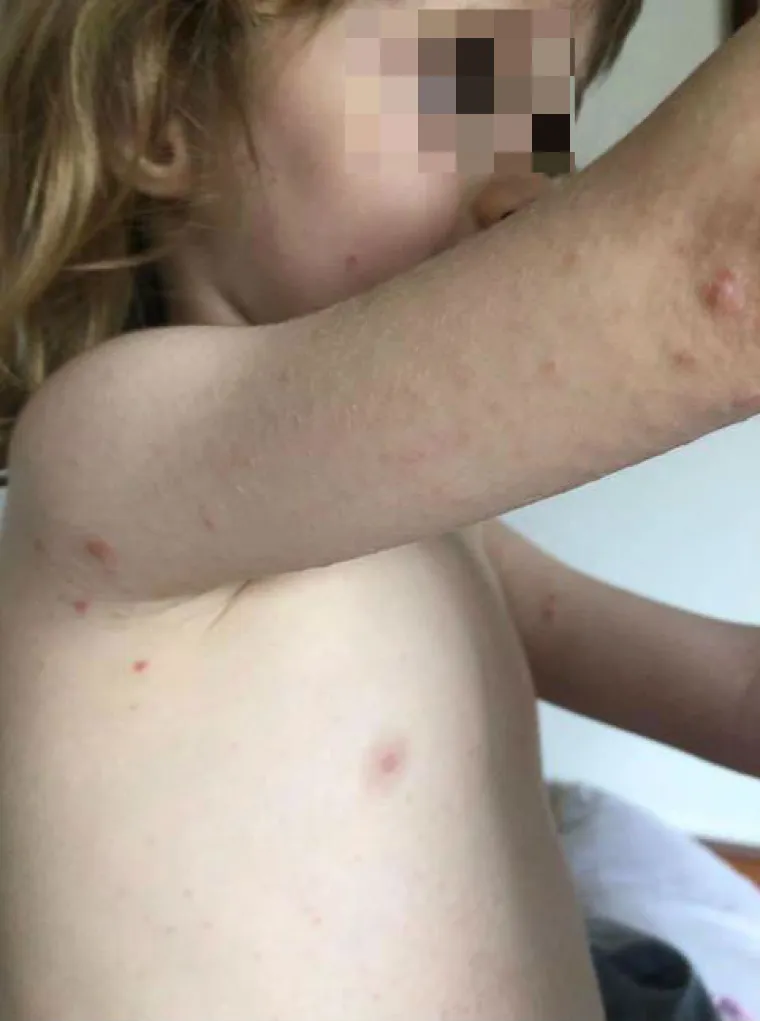 Prvo se razboljela kćerkica, a ubrzo su se temperatura i plikovi pojavili i kod roditelja