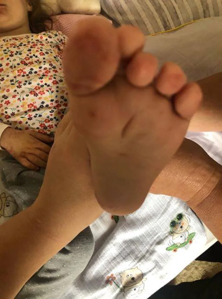 Prvo se razboljela kćerkica, a ubrzo su se temperatura i plikovi pojavili i kod roditelja