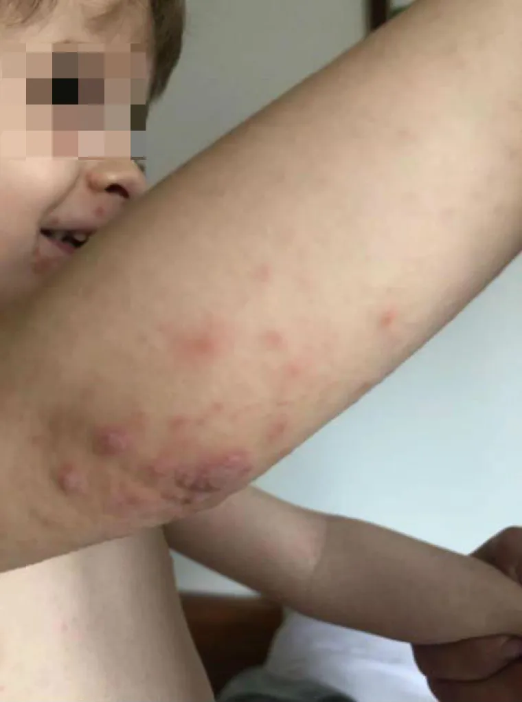 Prvo se razboljela kćerkica, a ubrzo su se temperatura i plikovi pojavili i kod roditelja