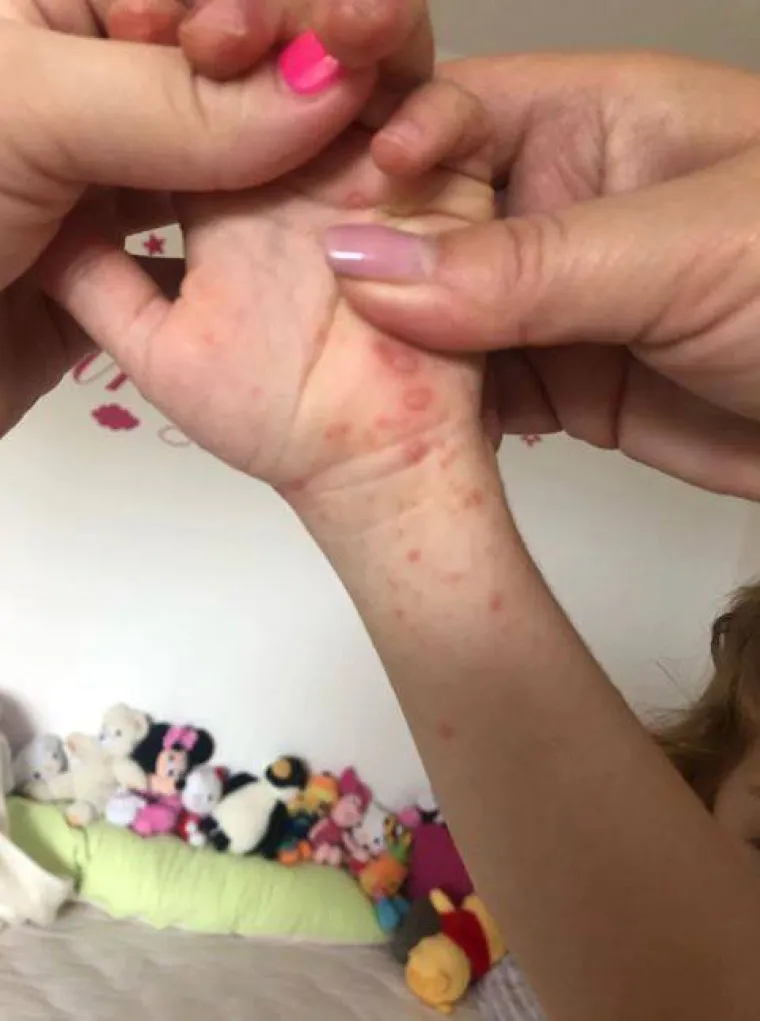 Prvo se razboljela kćerkica, a ubrzo su se temperatura i plikovi pojavili i kod roditelja