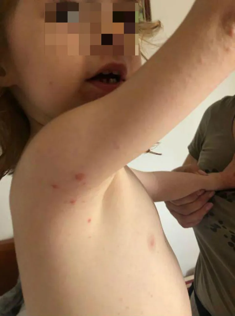 Prvo se razboljela kćerkica, a ubrzo su se temperatura i plikovi pojavili i kod roditelja