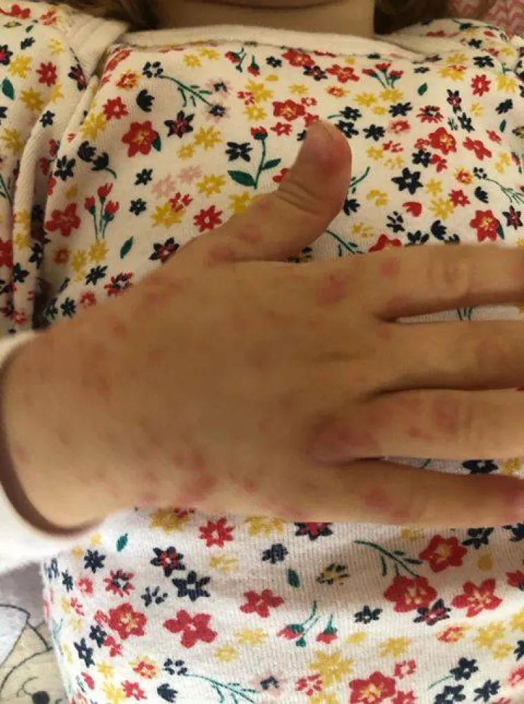 Prvo se razboljela kćerkica, a ubrzo su se temperatura i plikovi pojavili i kod roditelja